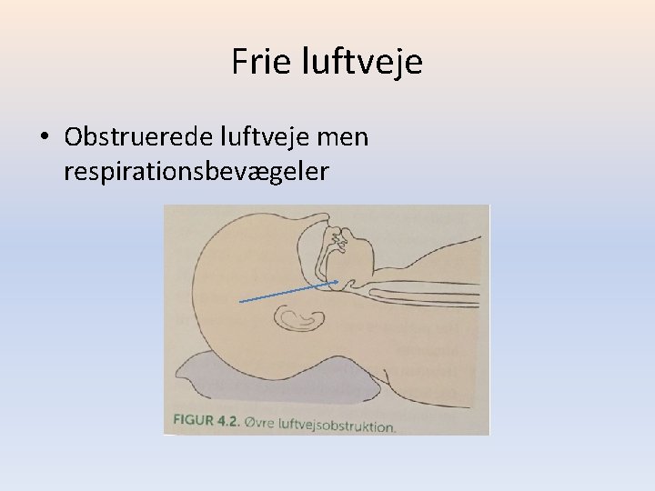 Frie luftveje • Obstruerede luftveje men respirationsbevægeler 