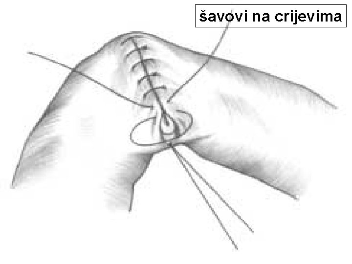 šavovi na crijevima 