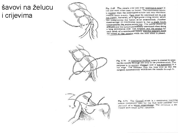 šavovi na želucu i crijevima 