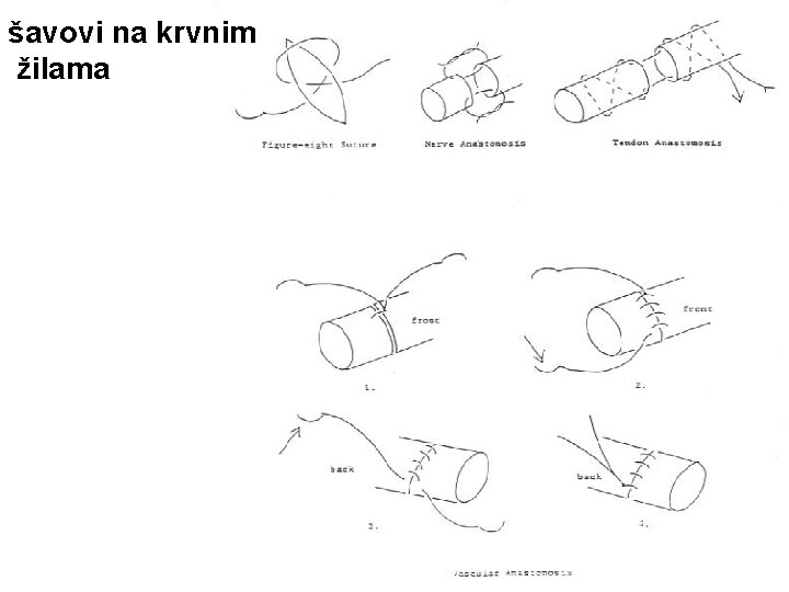 šavovi na krvnim žilama 