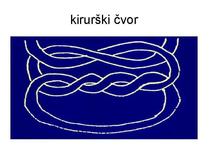 kirurški čvor 