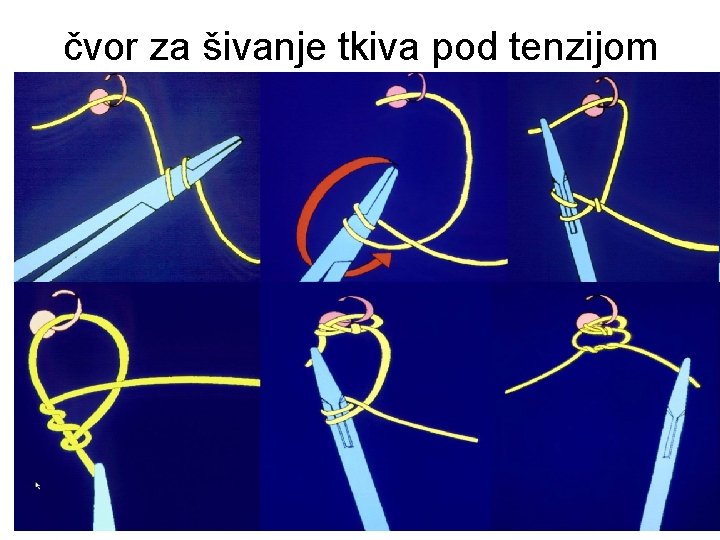  čvor za šivanje tkiva pod tenzijom 