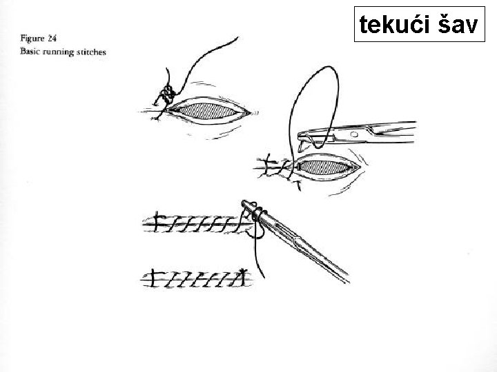 tekući šav 