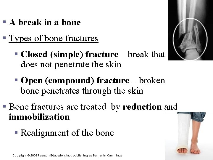 Bone Fractures § A break in a bone § Types of bone fractures §