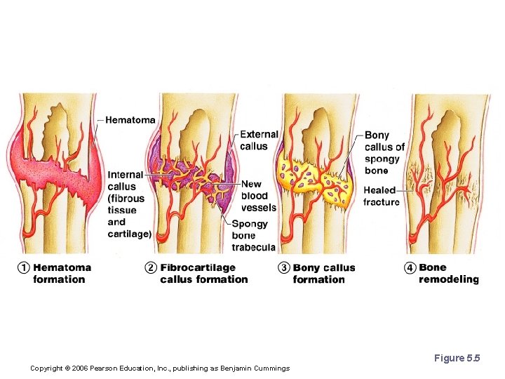 Stages in the Healing of a Bone Fracture Figure 5. 5 Copyright © 2006