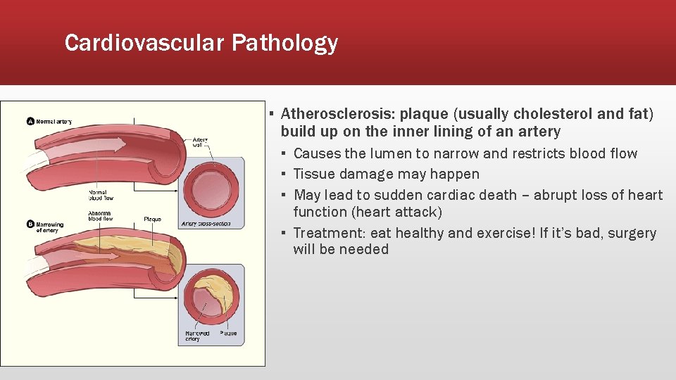 Cardiovascular Pathology ▪ Atherosclerosis: plaque (usually cholesterol and fat) build up on the inner