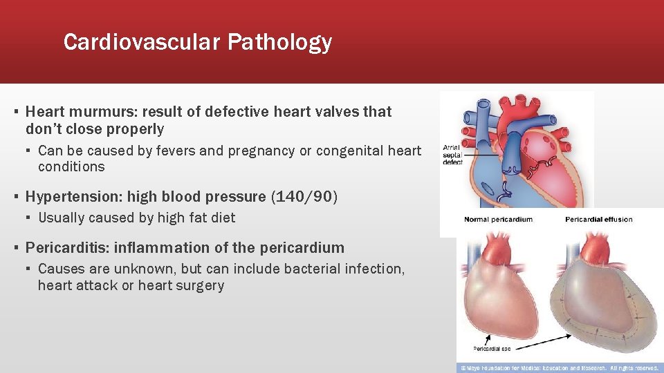 Cardiovascular Pathology ▪ Heart murmurs: result of defective heart valves that don’t close properly