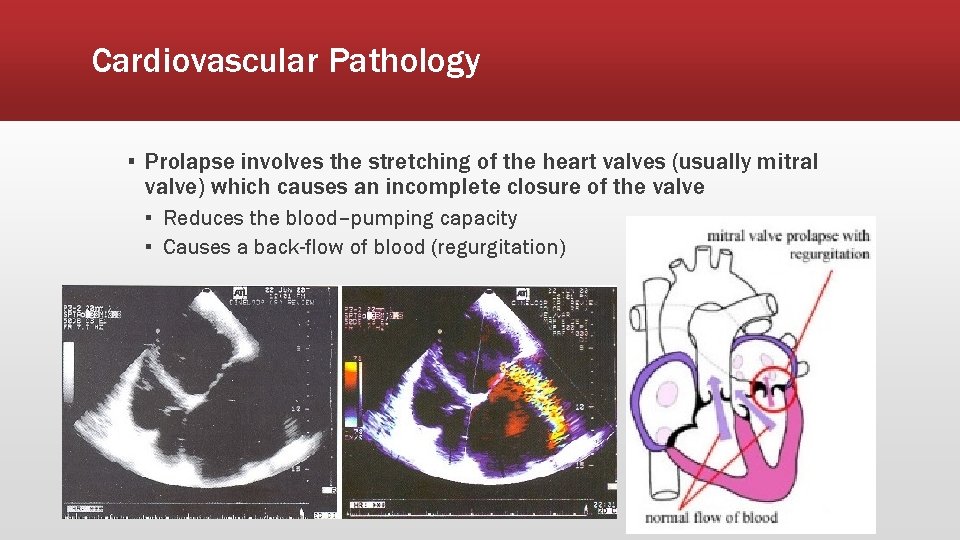 Cardiovascular Pathology ▪ Prolapse involves the stretching of the heart valves (usually mitral valve)