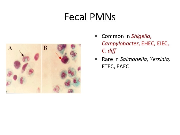 Fecal PMNs • Common in Shigella, Campylobacter, EHEC, EIEC, C. diff • Rare in