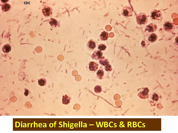 CDC Diarrhea of Shigella – WBCs & RBCs 