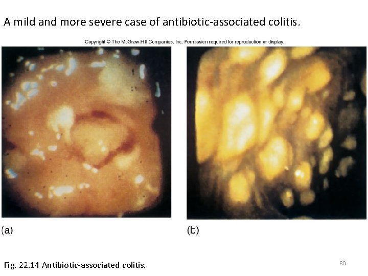 A mild and more severe case of antibiotic-associated colitis. Fig. 22. 14 Antibiotic-associated colitis.