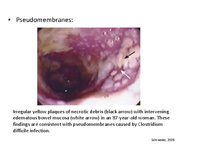  • Pseudomembranes: Irregular yellow plaques of necrotic debris (black arrow) with intervening edematous