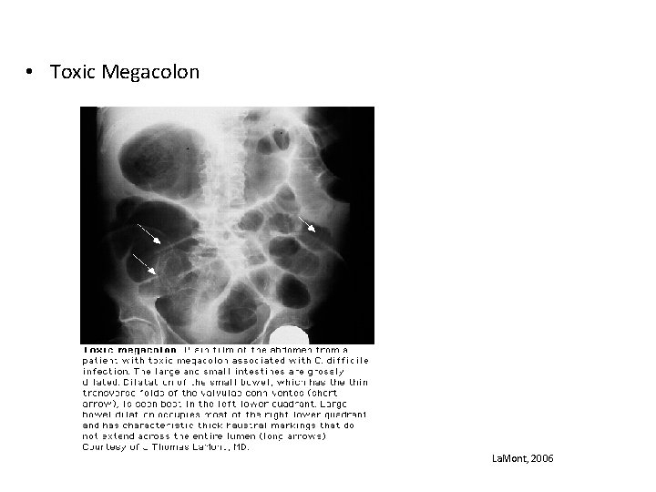  • Toxic Megacolon La. Mont, 2006 