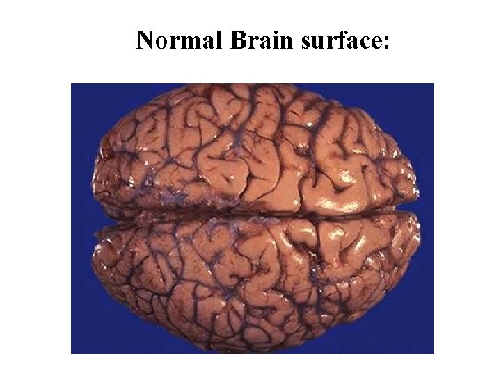 Normal Brain surface: 