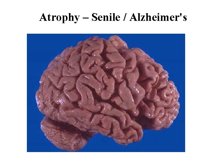 Atrophy – Senile / Alzheimer's 