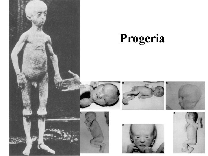 Progeria 