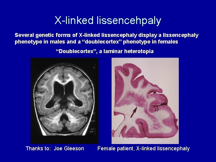 X-linked lissencehpaly Several genetic forms of X-linked lissencephaly display a lissencephaly phenotype in males