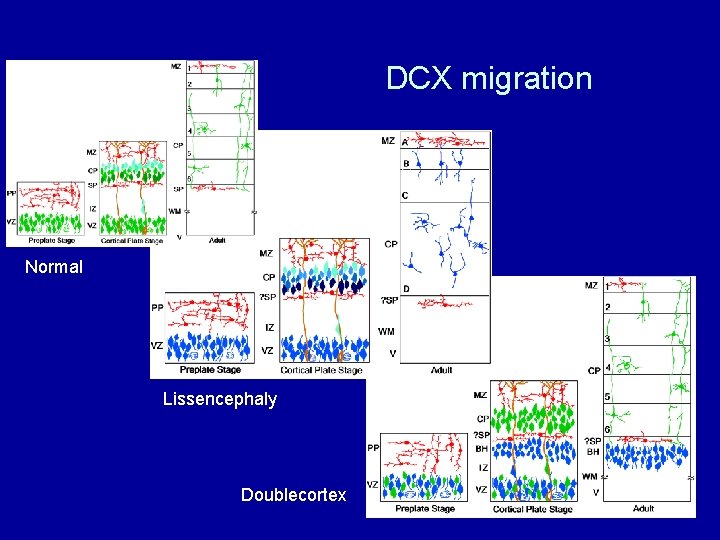 DCX migration Normal Lissencephaly Doublecortex 