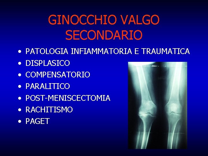 GINOCCHIO VALGO SECONDARIO • • PATOLOGIA INFIAMMATORIA E TRAUMATICA DISPLASICO COMPENSATORIO PARALITICO POST-MENISCECTOMIA RACHITISMO