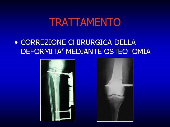 TRATTAMENTO • CORREZIONE CHIRURGICA DELLA DEFORMITA’ MEDIANTE OSTEOTOMIA 