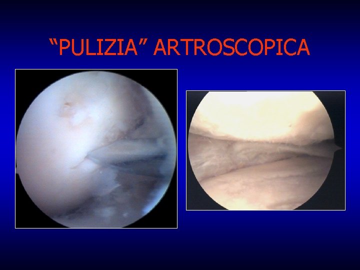 “PULIZIA” ARTROSCOPICA 