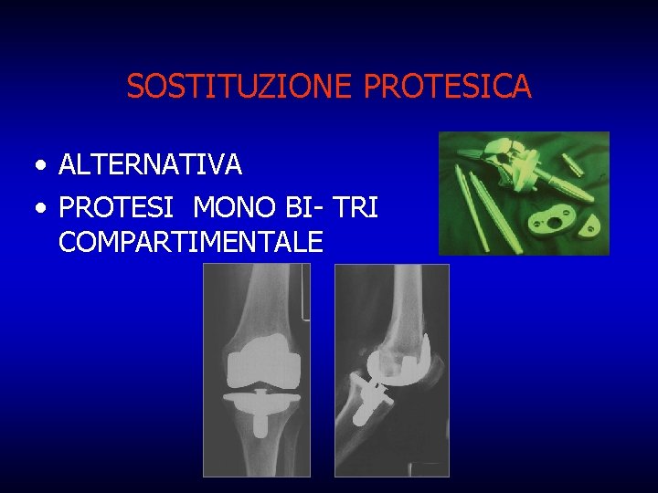 SOSTITUZIONE PROTESICA • ALTERNATIVA • PROTESI MONO BI- TRI COMPARTIMENTALE 