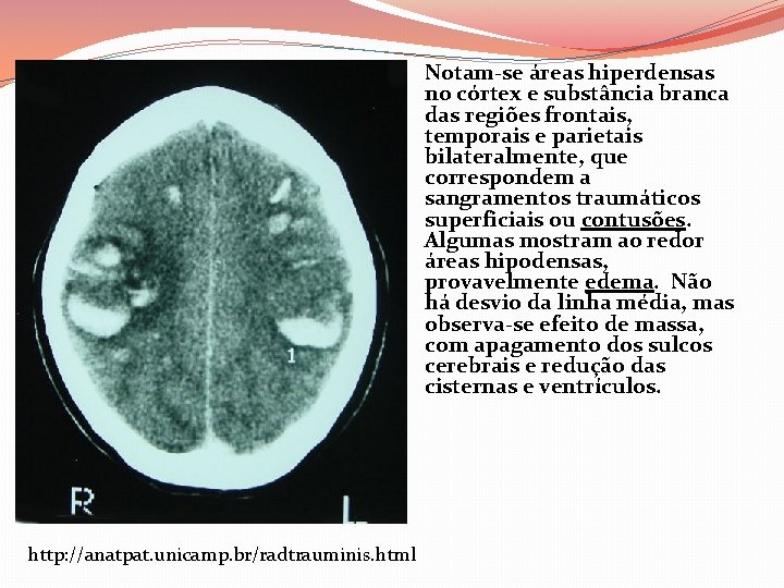 Notam-se áreas hiperdensas no córtex e substância branca das regiões frontais, temporais e parietais