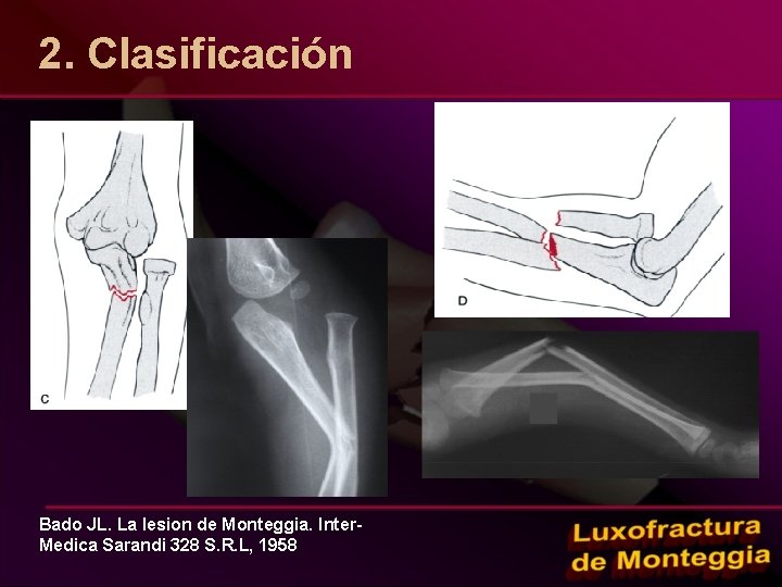 2. Clasificación Bado JL. La lesion de Monteggia. Inter. Medica Sarandi 328 S. R.