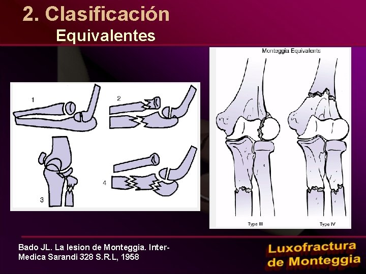 2. Clasificación Equivalentes Bado JL. La lesion de Monteggia. Inter. Medica Sarandi 328 S.