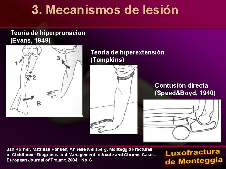 3. Mecanismos de lesión Teoría de hiperpronacion (Evans, 1949) Teoría de hiperextensión (Tompkins) Contusión