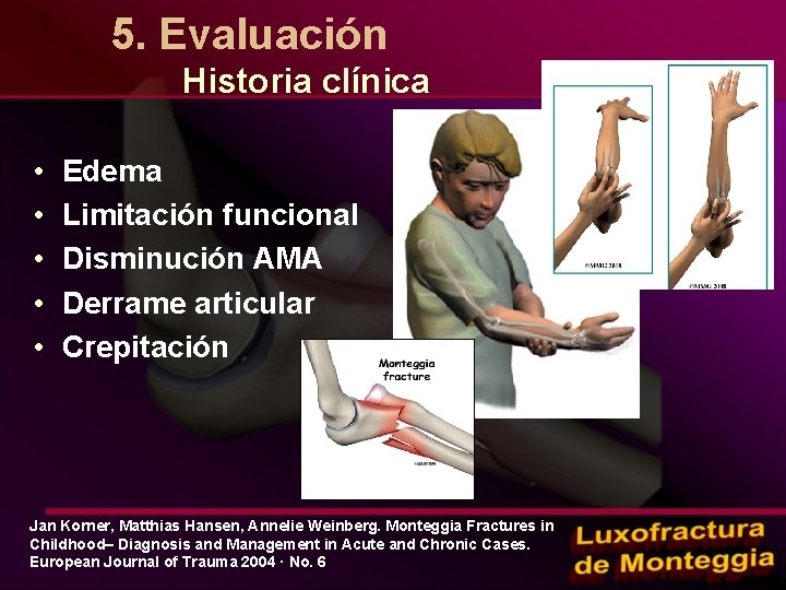 5. Evaluación Historia clínica • • • Edema Limitación funcional Disminución AMA Derrame articular