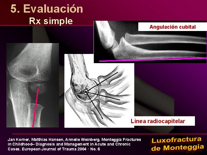 5. Evaluación Rx simple Angulación cubital Linea radiocapitelar Jan Korner, Matthias Hansen, Annelie Weinberg.