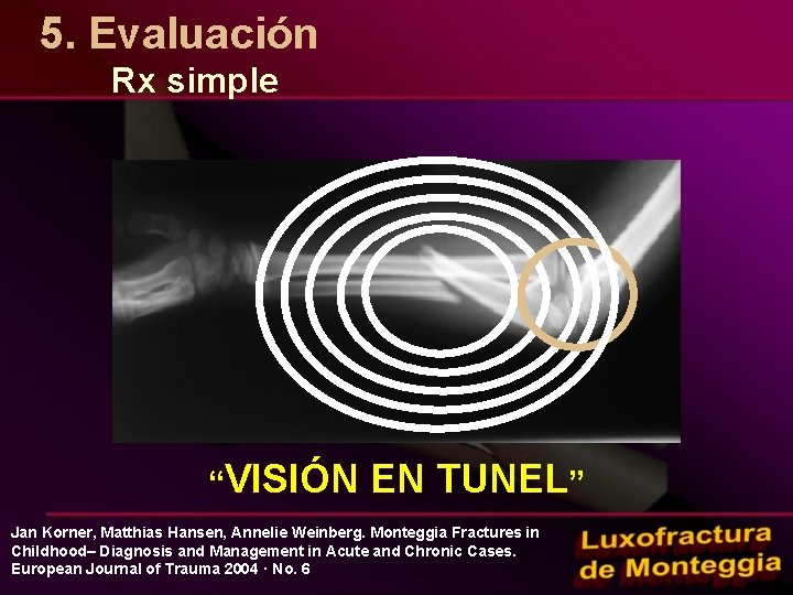5. Evaluación Rx simple “VISIÓN EN TUNEL” Jan Korner, Matthias Hansen, Annelie Weinberg. Monteggia