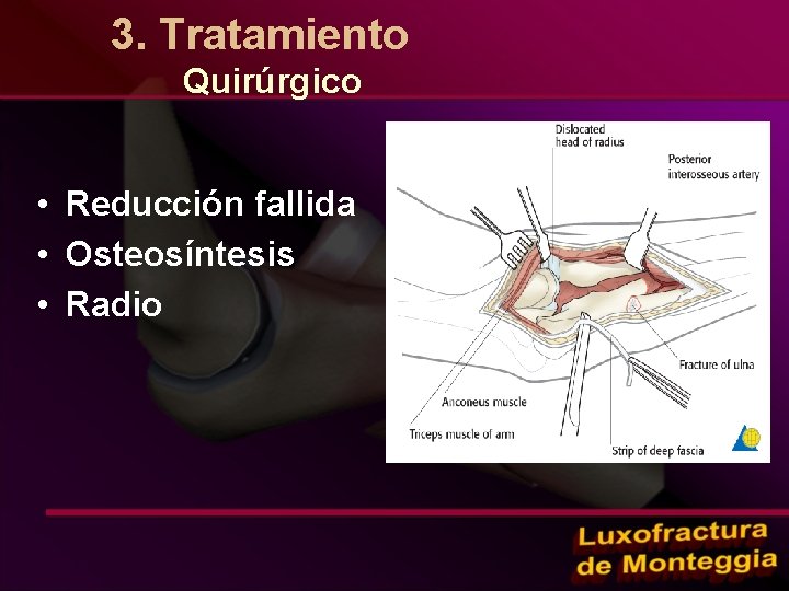 3. Tratamiento Quirúrgico • Reducción fallida • Osteosíntesis • Radio 