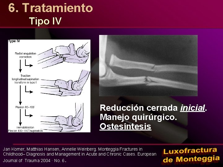 6. Tratamiento Tipo IV Reducción cerrada inicial. Manejo quirúrgico. Ostesíntesis Jan Korner, Matthias Hansen,