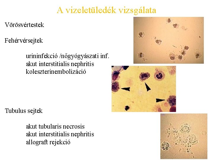 A vizeletüledék vizsgálata Vörösvértestek Fehérvérsejtek urininfekció /nőgyógyászati inf. akut interstitialis nephritis koleszterinembolizáció Tubulus sejtek