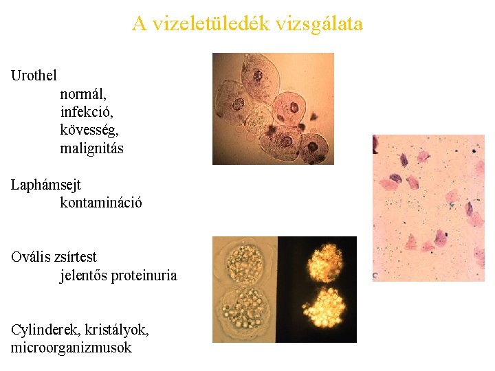 A vizeletüledék vizsgálata Urothel normál, infekció, kövesség, malignitás Laphámsejt kontamináció Ovális zsírtest jelentős proteinuria