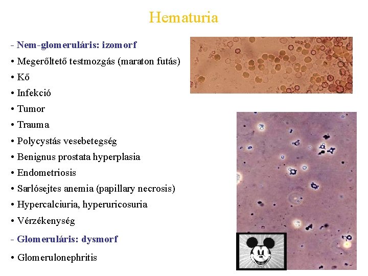 Hematuria - Nem-glomeruláris: izomorf • Megerőltető testmozgás (maraton futás) • Kő • Infekció •