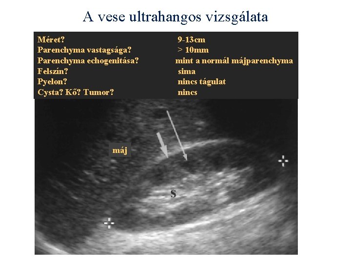 A vese ultrahangos vizsgálata Méret? Parenchyma vastagsága? Parenchyma echogenitása? Felszín? Pyelon? Cysta? Kő? Tumor?