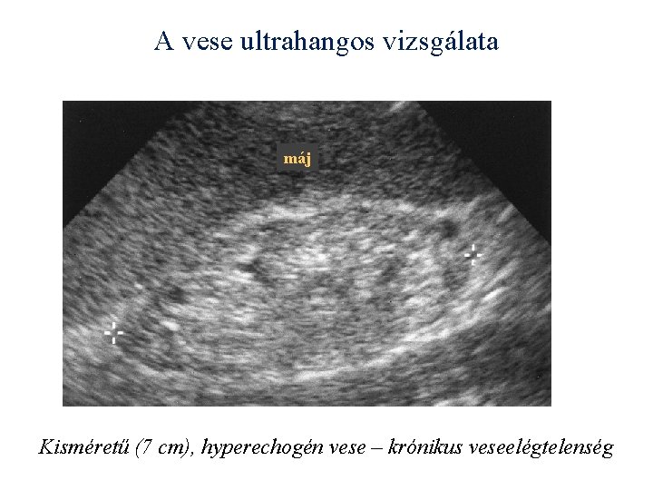 A vese ultrahangos vizsgálata máj Kisméretű (7 cm), hyperechogén vese – krónikus veseelégtelenség 