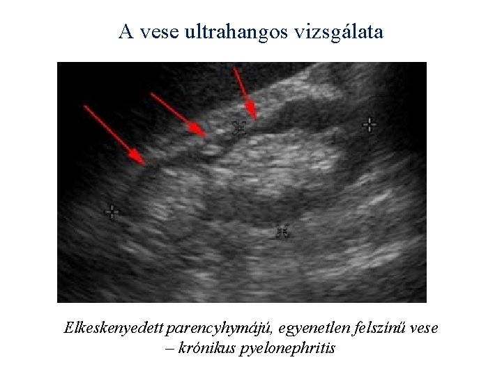 A vese ultrahangos vizsgálata Elkeskenyedett parencyhymájú, egyenetlen felszínű vese – krónikus pyelonephritis 