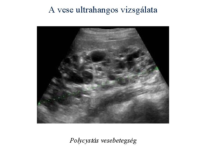 A vese ultrahangos vizsgálata Polycystás vesebetegség A vese ultrahangos vizsgálata Polycystás vesebetegség