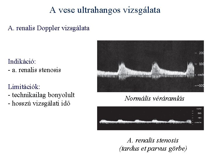 A vese ultrahangos vizsgálata A. renalis Doppler vizsgálata Indikáció: - a. renalis stenosis Limitációk: