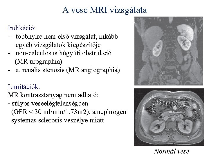 A vese MRI vizsgálata Indikáció: - többnyire nem első vizsgálat, inkább egyéb vizsgálatok kiegészítője