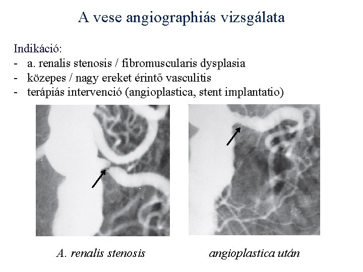 A vese angiographiás vizsgálata Indikáció: - a. renalis stenosis / fibromuscularis dysplasia - közepes