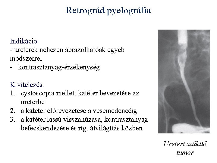 Retrográd pyelográfia Indikáció: - ureterek nehezen ábrázolhatóak egyéb módszerrel - kontrasztanyag-érzékenység Kivitelezés: 1. cystoscopia