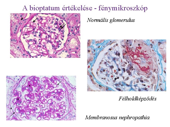 A bioptatum értékelése - fénymikroszkóp Normális glomerulus Félholdképződés Membranosus nephropathia 