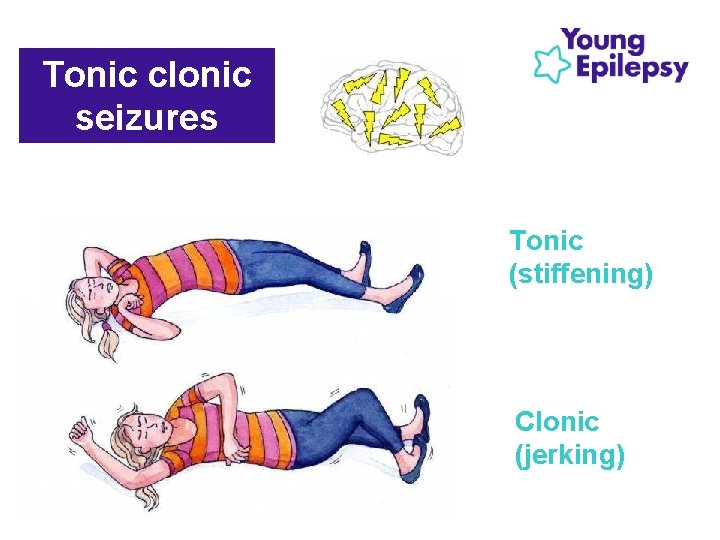 Tonic clonic seizures Tonic (stiffening) Clonic (jerking) Tonic clonic seizures Tonic (stiffening) Clonic (jerking)
