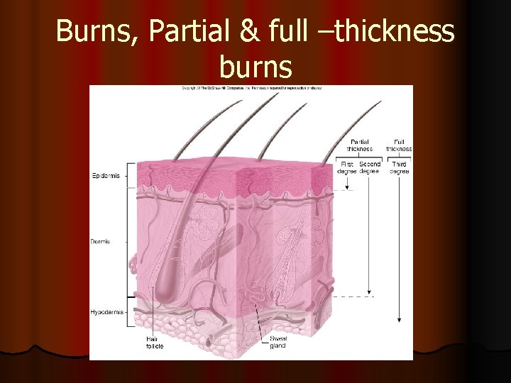 Burns, Partial & full –thickness burns 