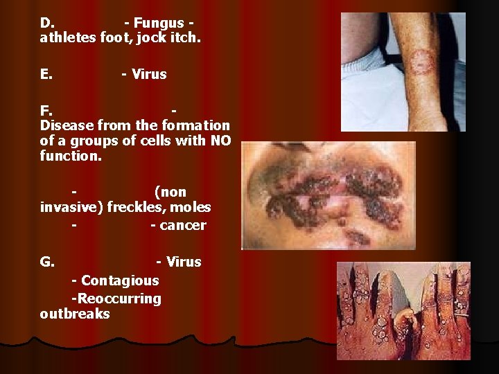 D. - Fungus athletes foot, jock itch. E. - Virus F. Disease from the